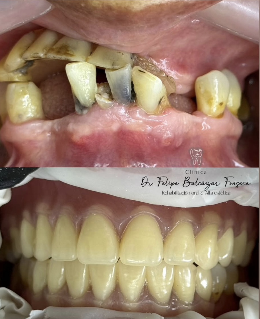 Carillas estéticas · transformación de sonrisa