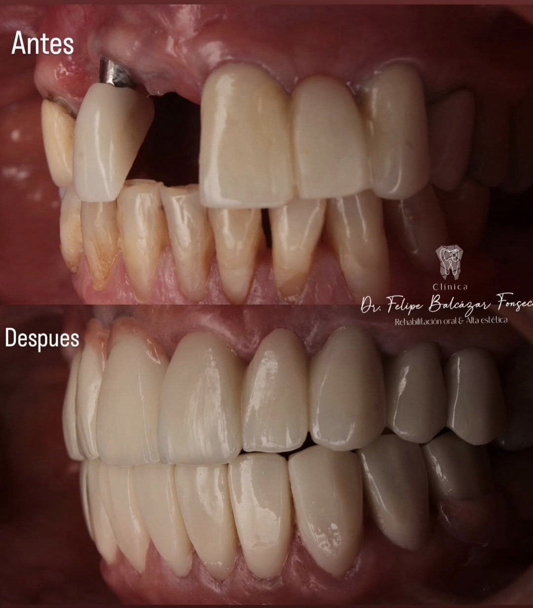 Implantes Dentales